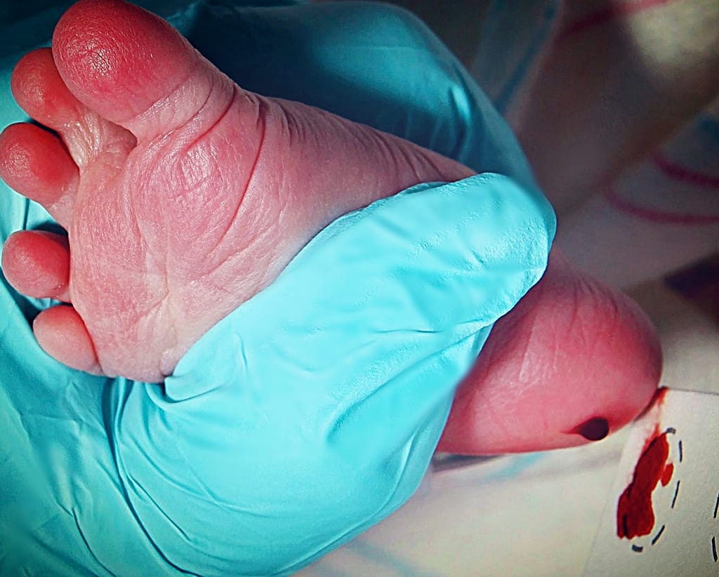 Newborn screening for sickle cell disease a heel prick