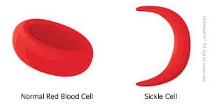 Sickle cell & Normal