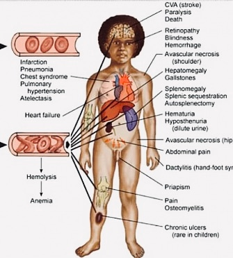 Symptoms caused by Sickle Cell Disease